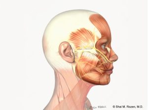 Cross Facial Nerve Graft (CFNG) | Shai M. Rozen, M.D., F.A.C.S.