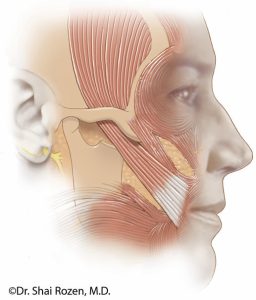 Temporalis Muscle Flap Surgery | Shai M. Rozen, M.D., F.A.C.S.