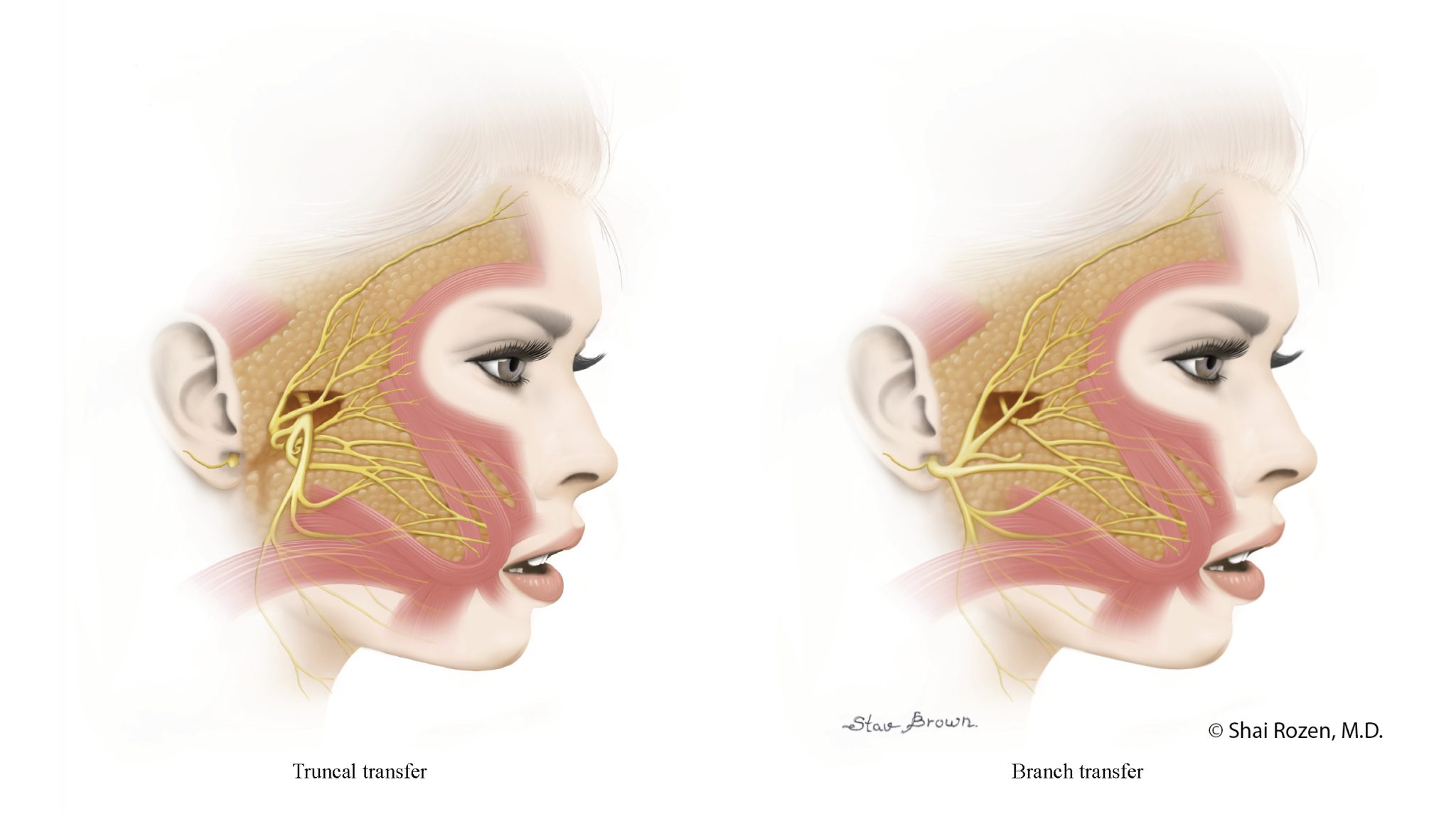 Nerve Transfer for Facial Paralysis | Shai M. Rozen, M.D., F.A.C.S.